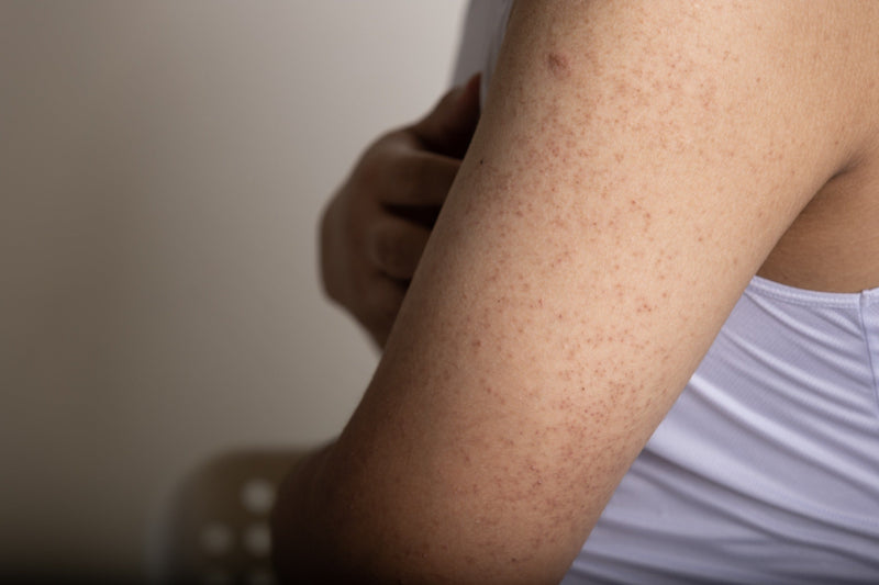 Keratosis Pilaris: What Causes Bumpy Skin and How to Smooth It Naturally - Osmia