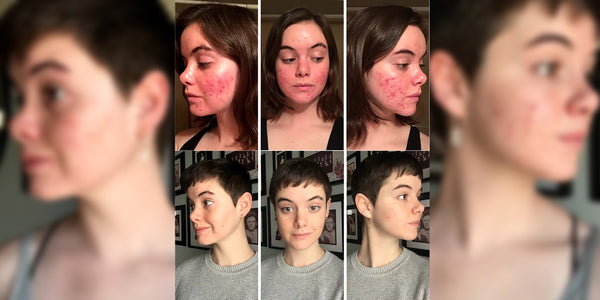 How I Healed My Acne Naturally - Osmia