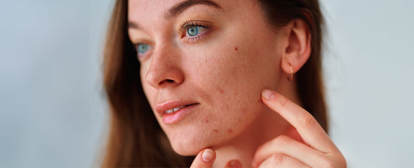 The Sensitive Skin Epidemic: What’s Really Causing It & How to Protect Your Skin - Osmia