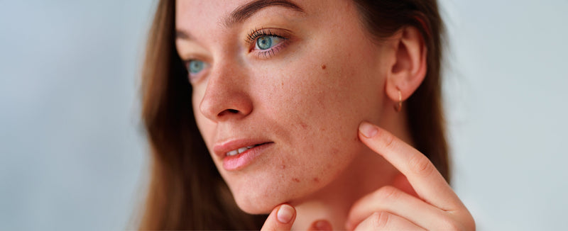 The Sensitive Skin Epidemic: What’s Really Causing It & How to Protect Your Skin - Osmia