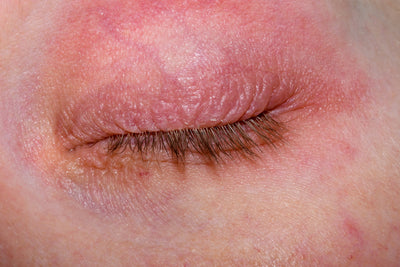 Eyelid Dermatitis: What's Causing It and How to Calm It Naturally - Osmia
